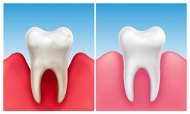 gengiva inflamada - gengivite